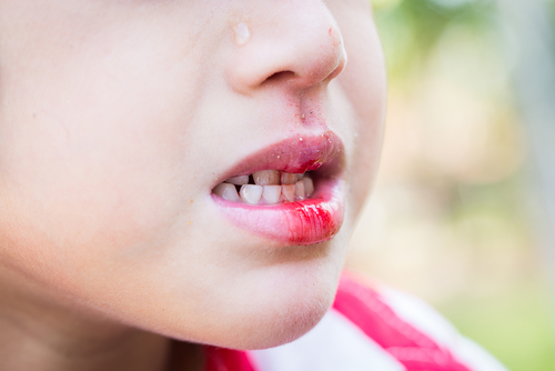 Traumatisme dentaire chez lenfant : comment réagir ?