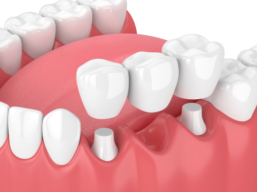 Bridge dentaire : une succession de couronnes artificielles